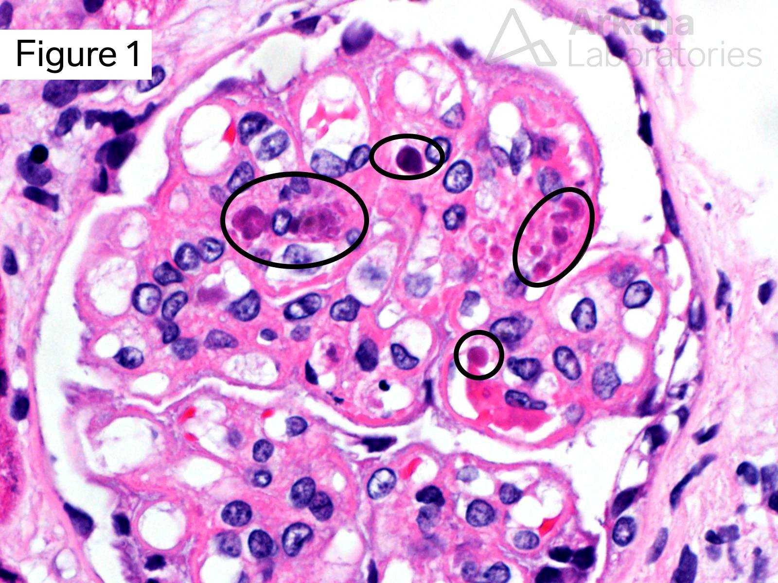 lupus nephritis