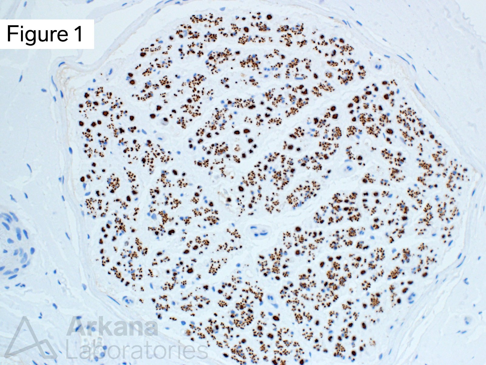 Small Unmyelinated Fibers Seen In Neurofilament Stain