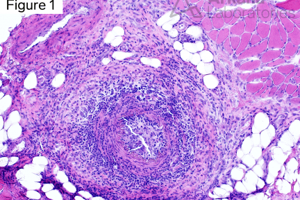 Oculopharyngeal Muscular Dystrophy (OPMD)