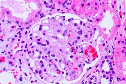 Thrombotic microangiopathy