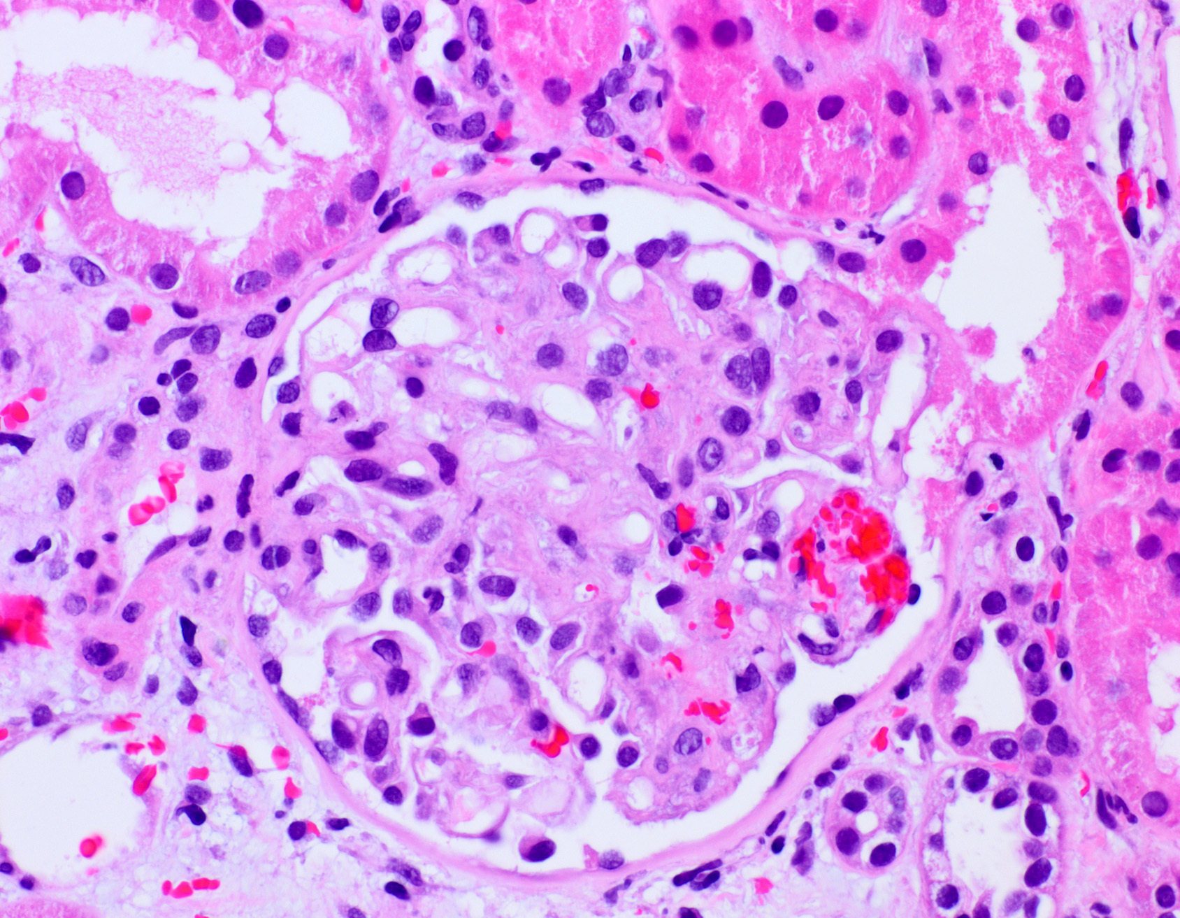 Thrombotic microangiopathy