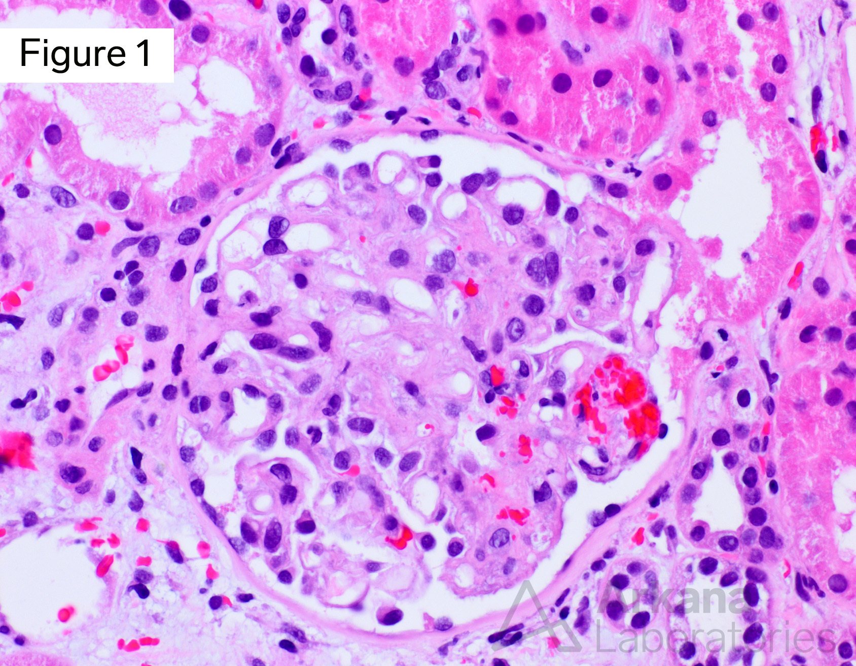 Thrombotic microangiopathy