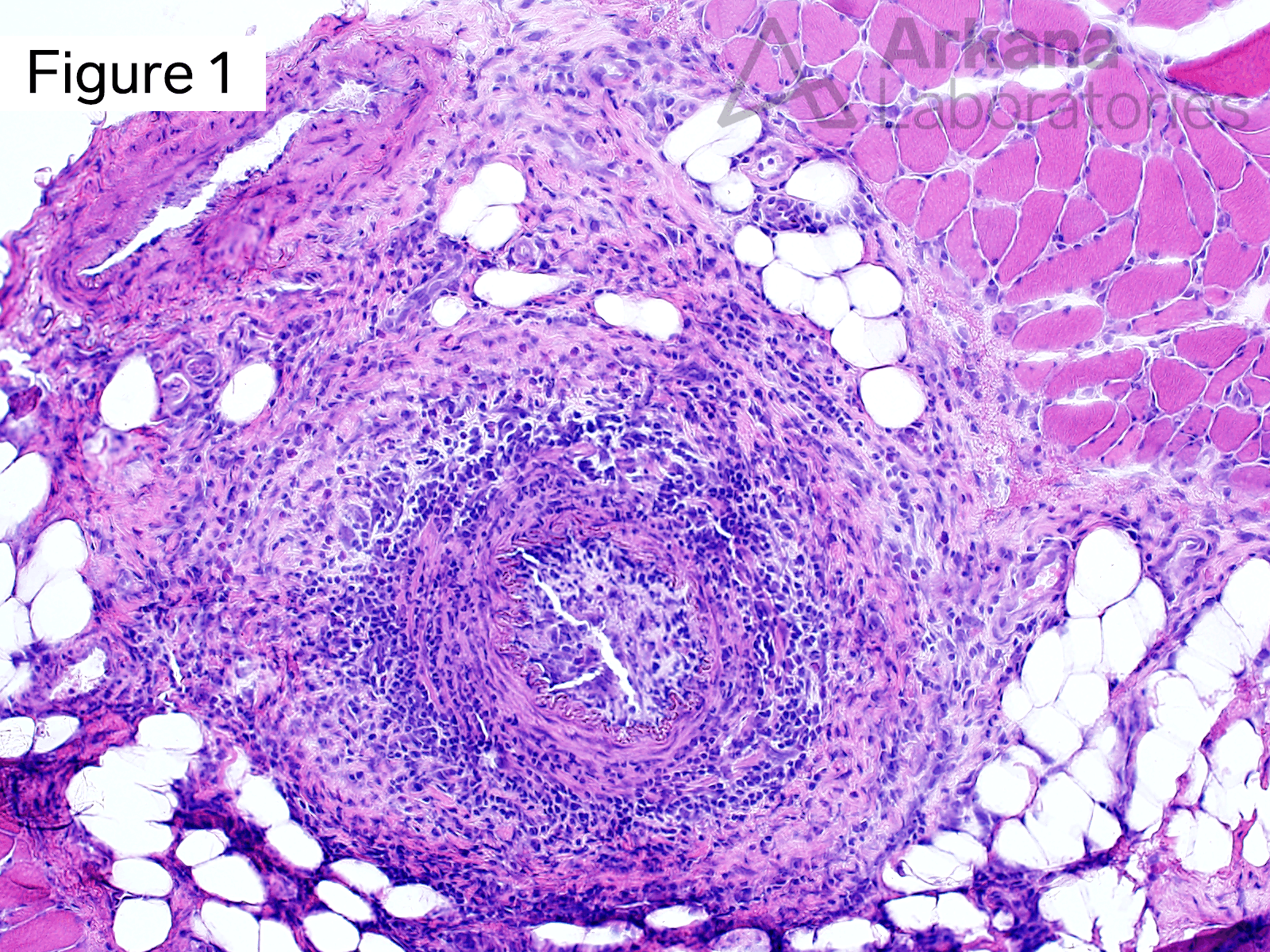 chronic inflammation around muscle artery showing vasculitis (“vasculitic myopathy”)