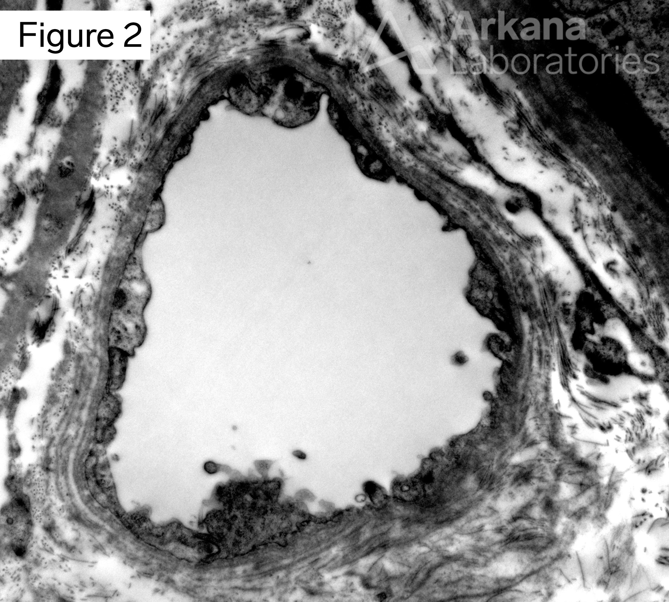 peritubular capillary basement membrane multilayering