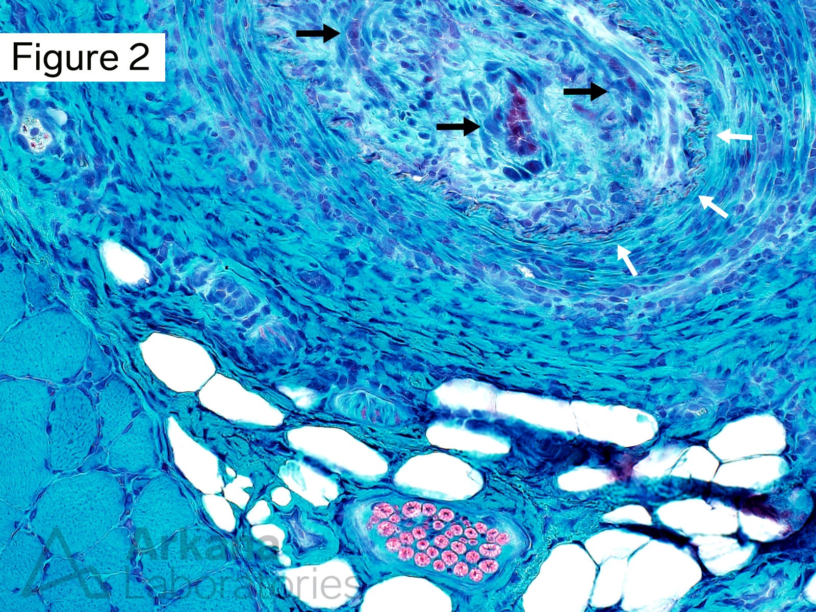 vasculitis (“vasculitic myopathy”)