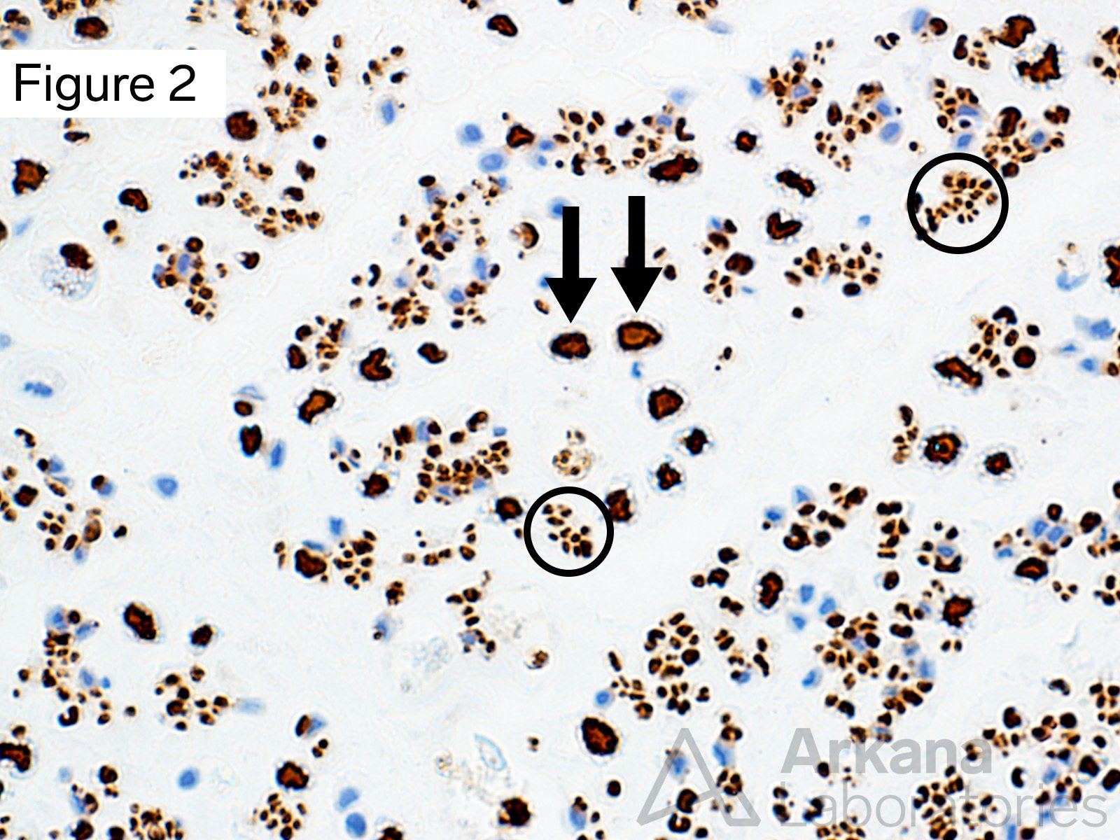 Small Unmyelinated Fibers Seen In Neurofilament Stain