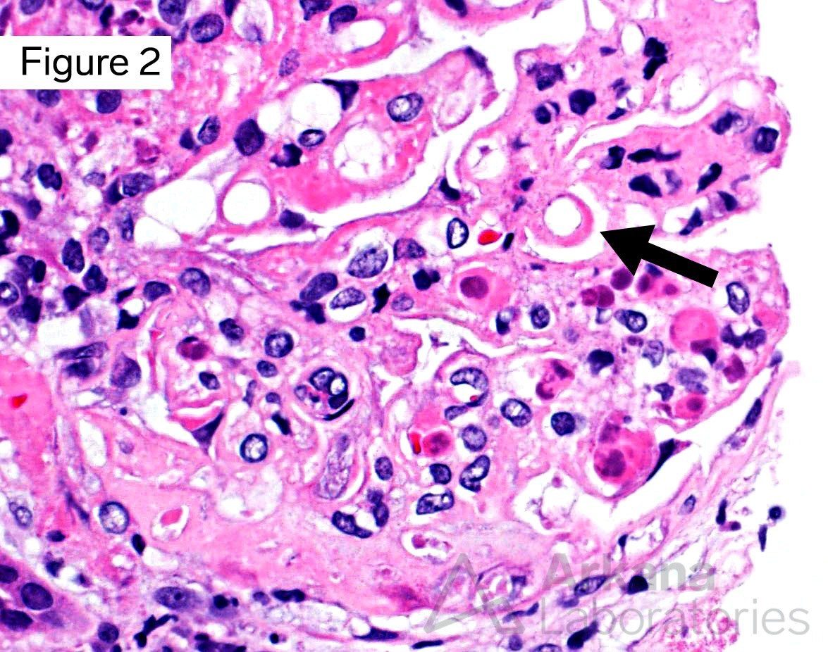 LE cells on a H&E stain