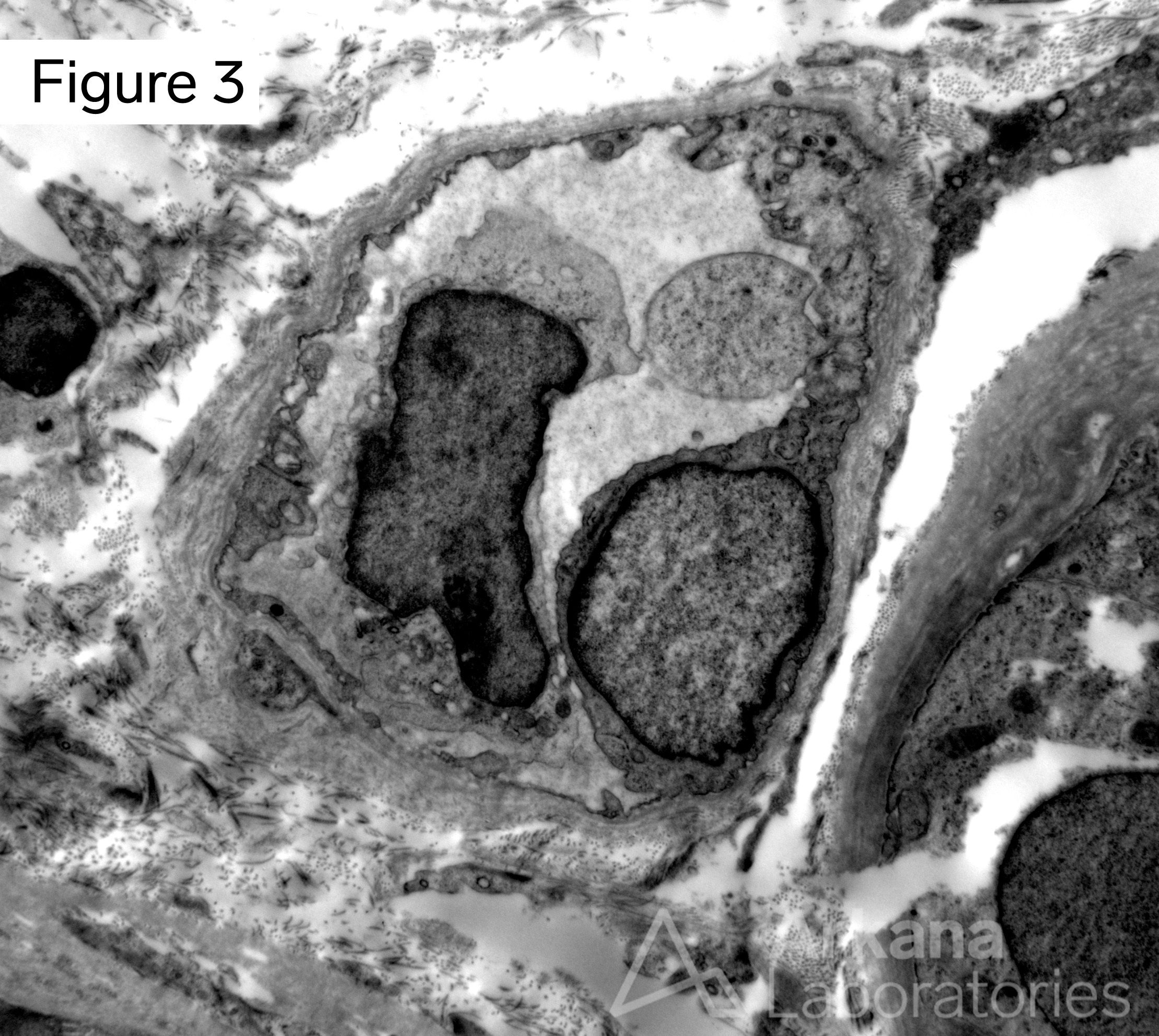 peritubular capillary basement membrane multilayering