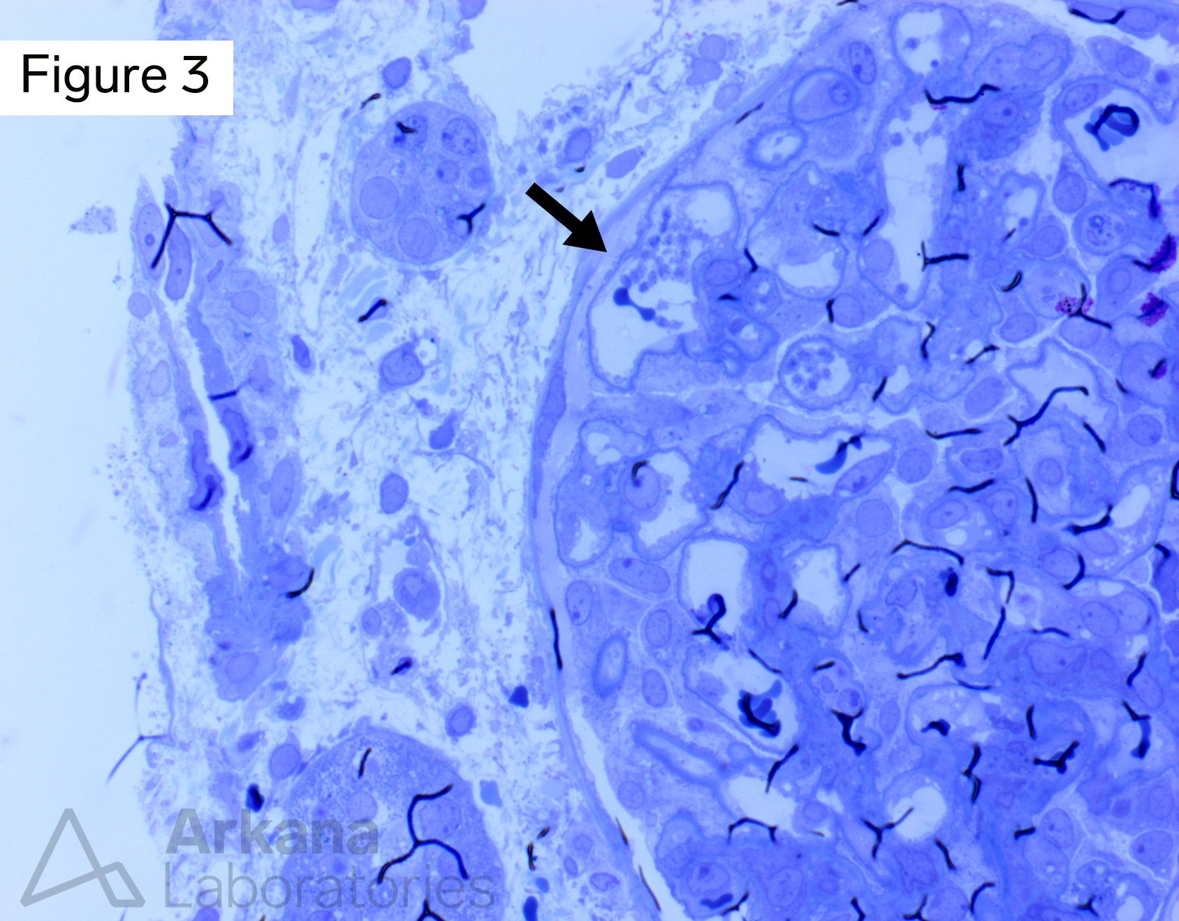 platelet aggregates on toluidine blue stain