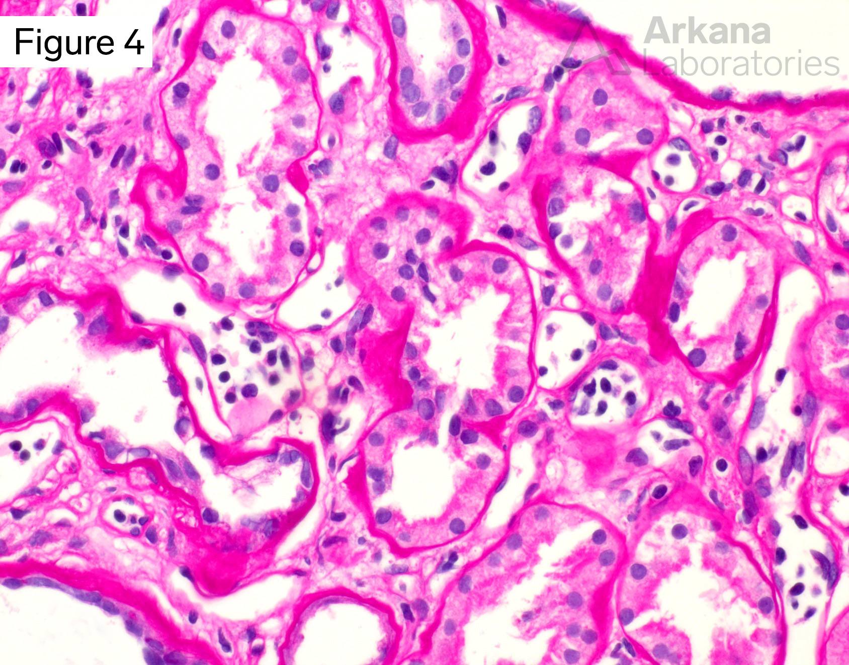 chronic antibody mediated rejection, glomerulitis and peritubular capillaritis