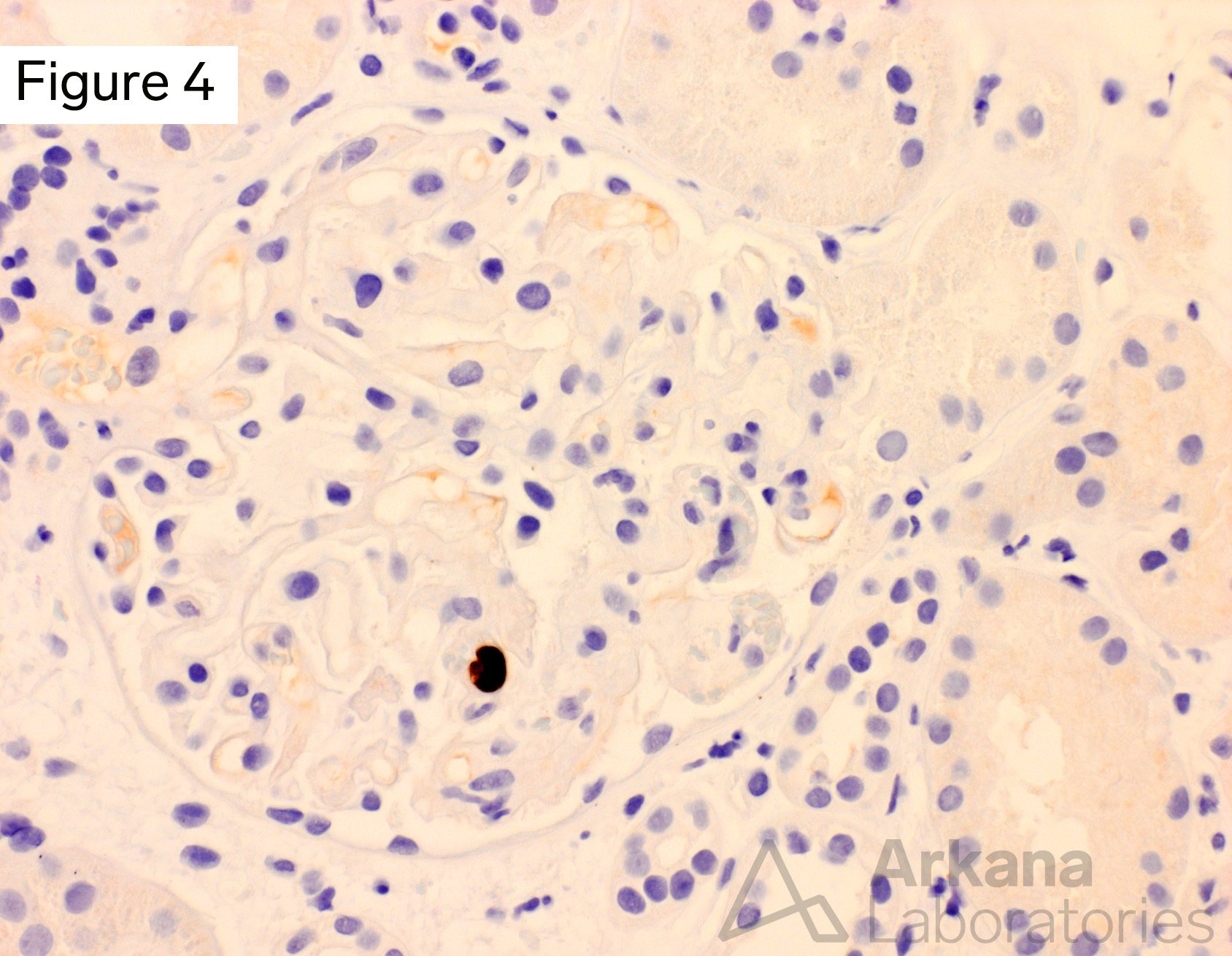 MV immunohistochemical stain was performed and was positive within a single glomerular endothelial cell