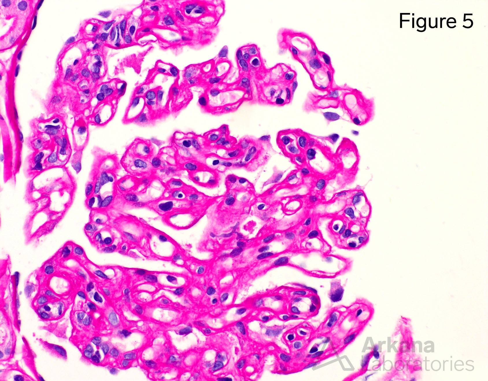 chronic antibody mediated rejection, glomerulitis and peritubular capillaritis