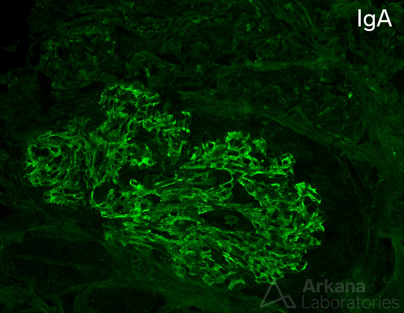 class IV lupus nephritis