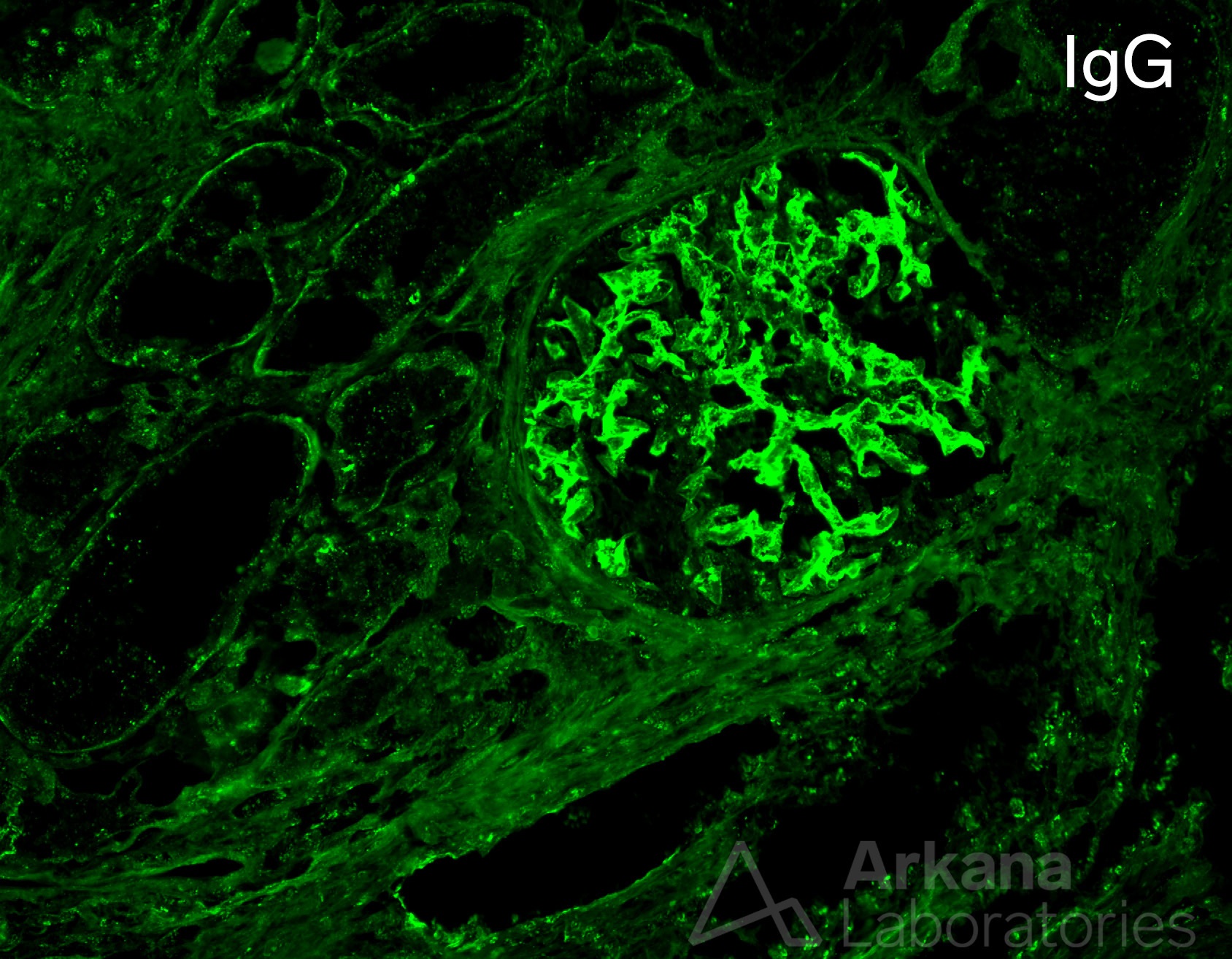 class IV lupus nephritis