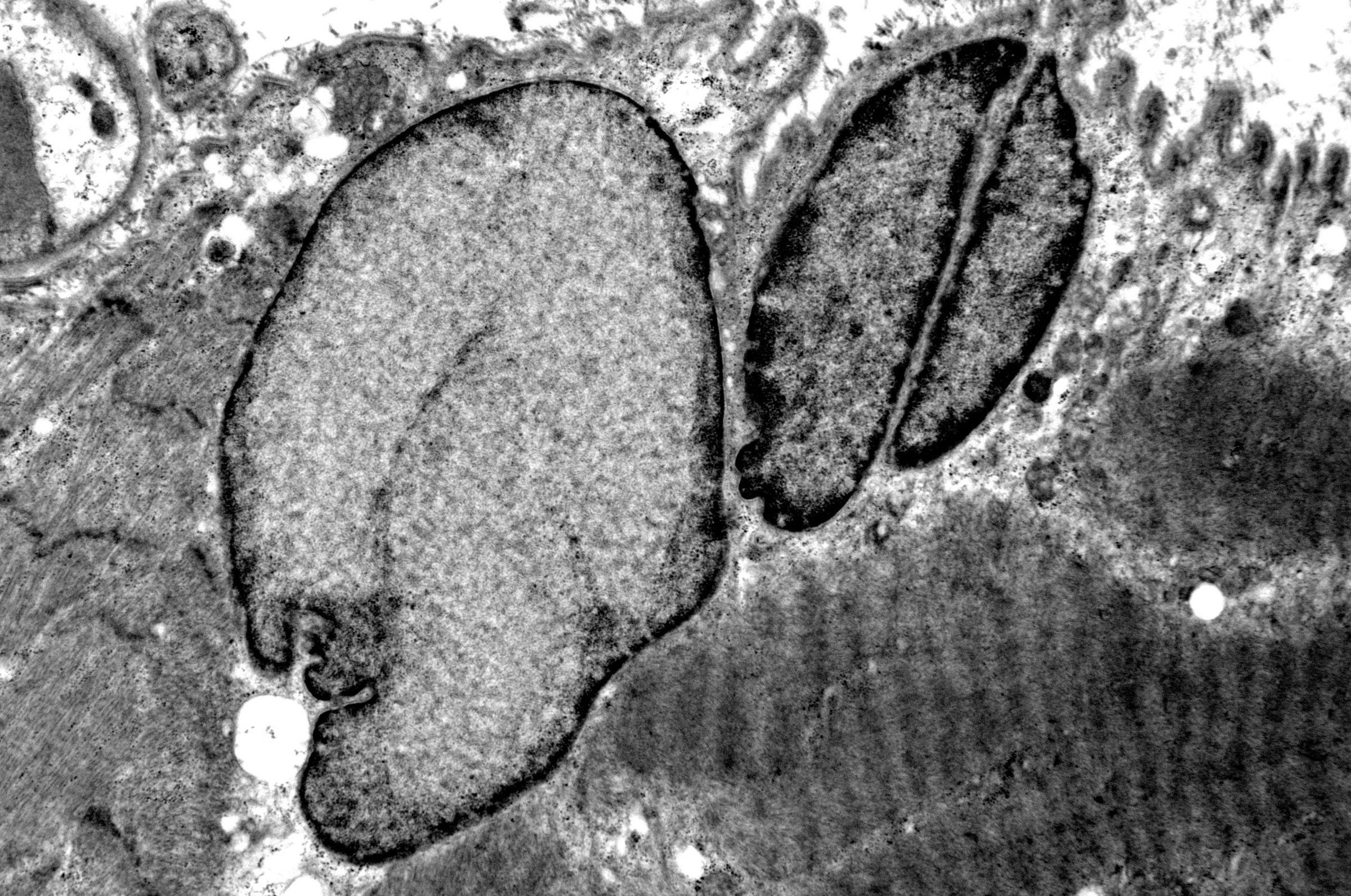 Oculopharyngeal Muscular Dystrophy