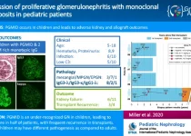 Progression of proliferative glomerulonephritis with monoclonal IgG deposits in pediatric patients graphical abstract
