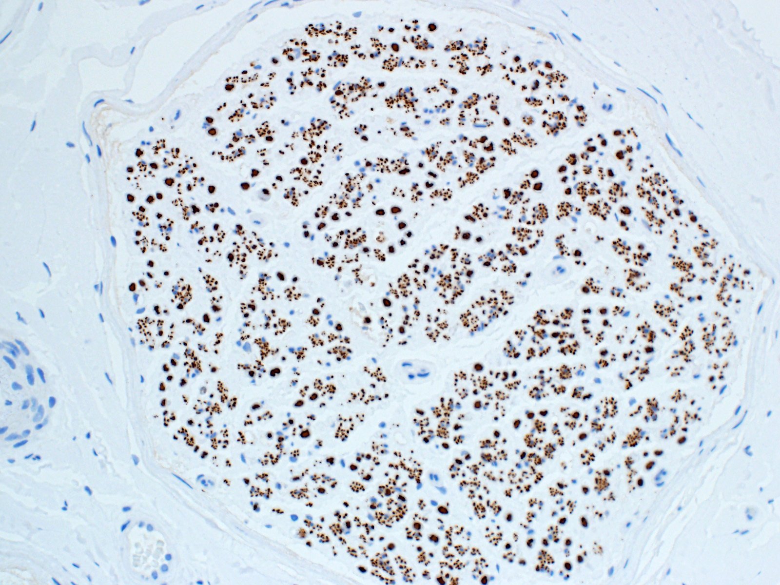 Small Unmyelinated Fibers Seen In Neurofilament Stain