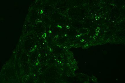 class IV lupus nephritis on IF stain