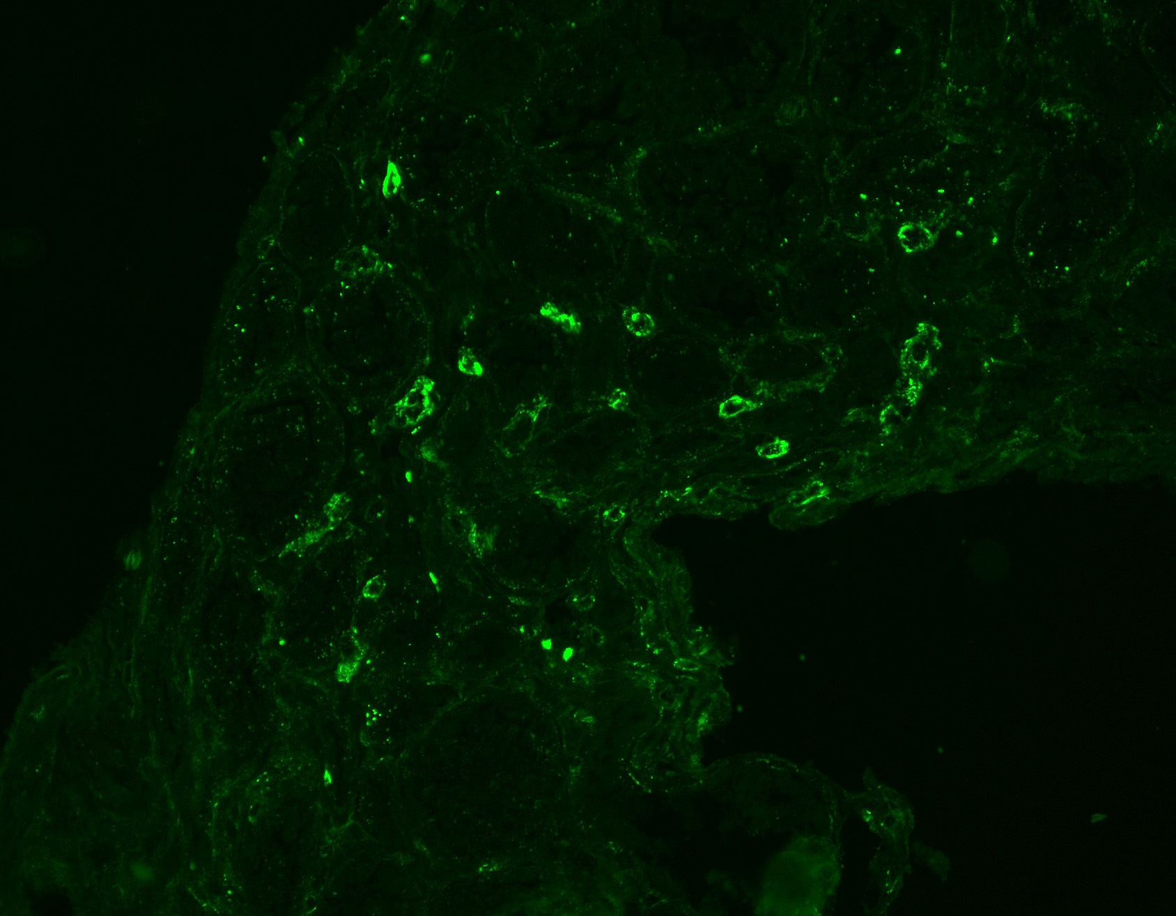 class IV lupus nephritis on IF stain