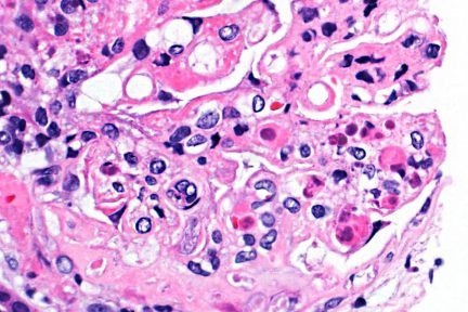 H&E stain showing numerous hematoxylin bodies