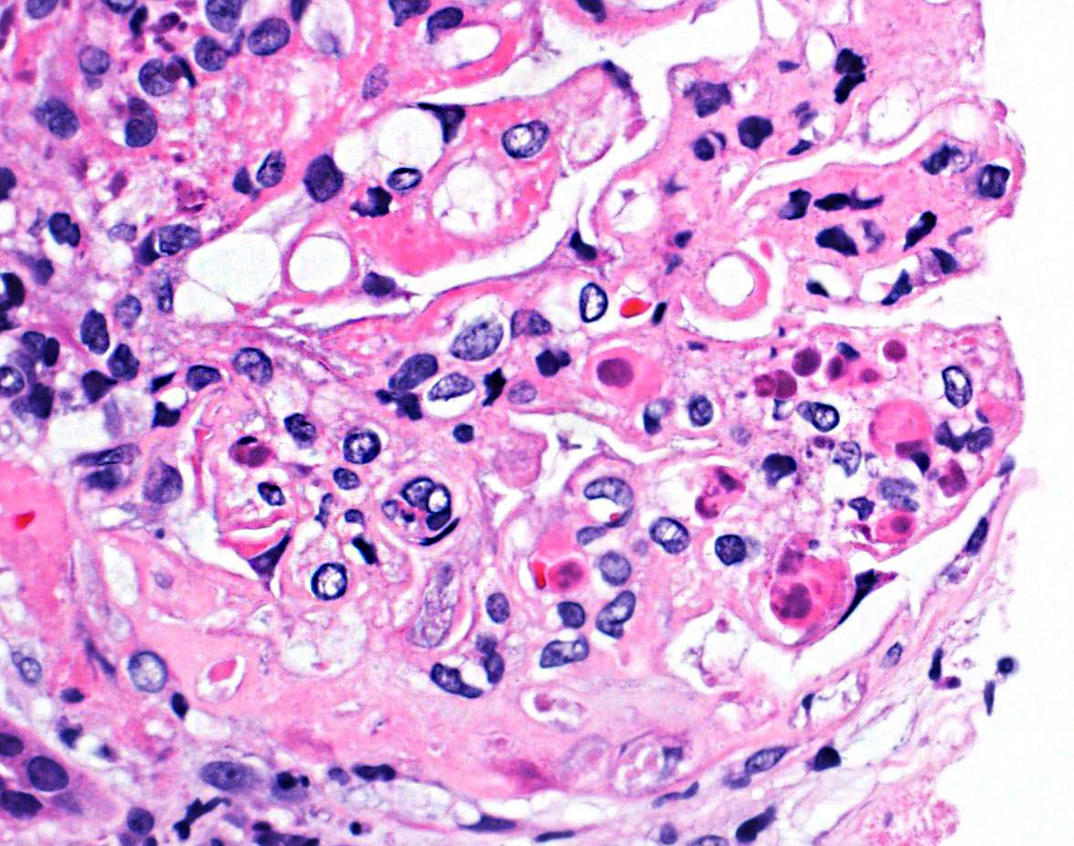H&E stain showing numerous hematoxylin bodies