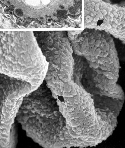 subepithelial immune deposits (arrows, not extracted) carpeting the GBM surface