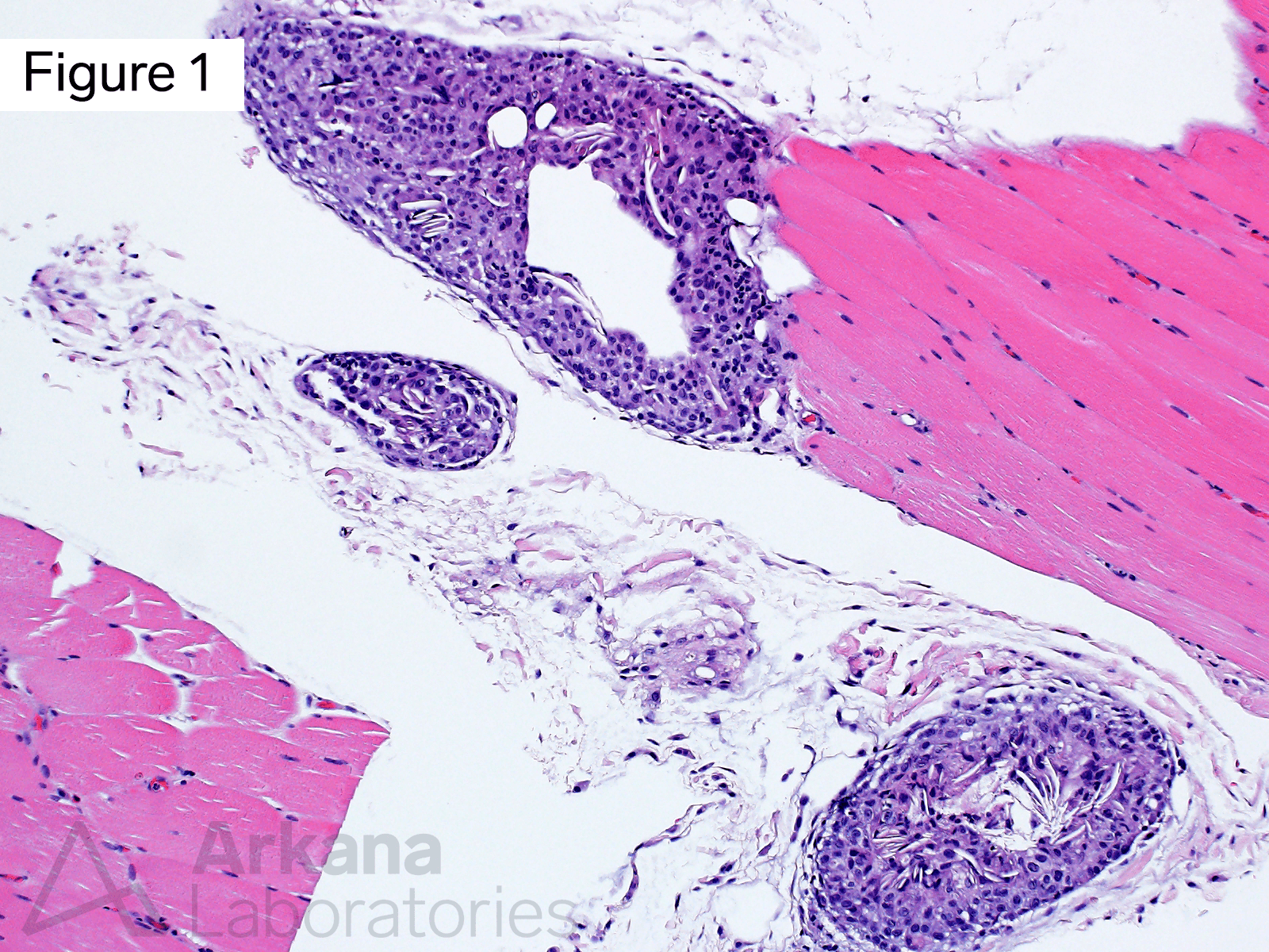 This medium magnification image shows multiple well-circumscribed areas of hypercellularity with the perimysium