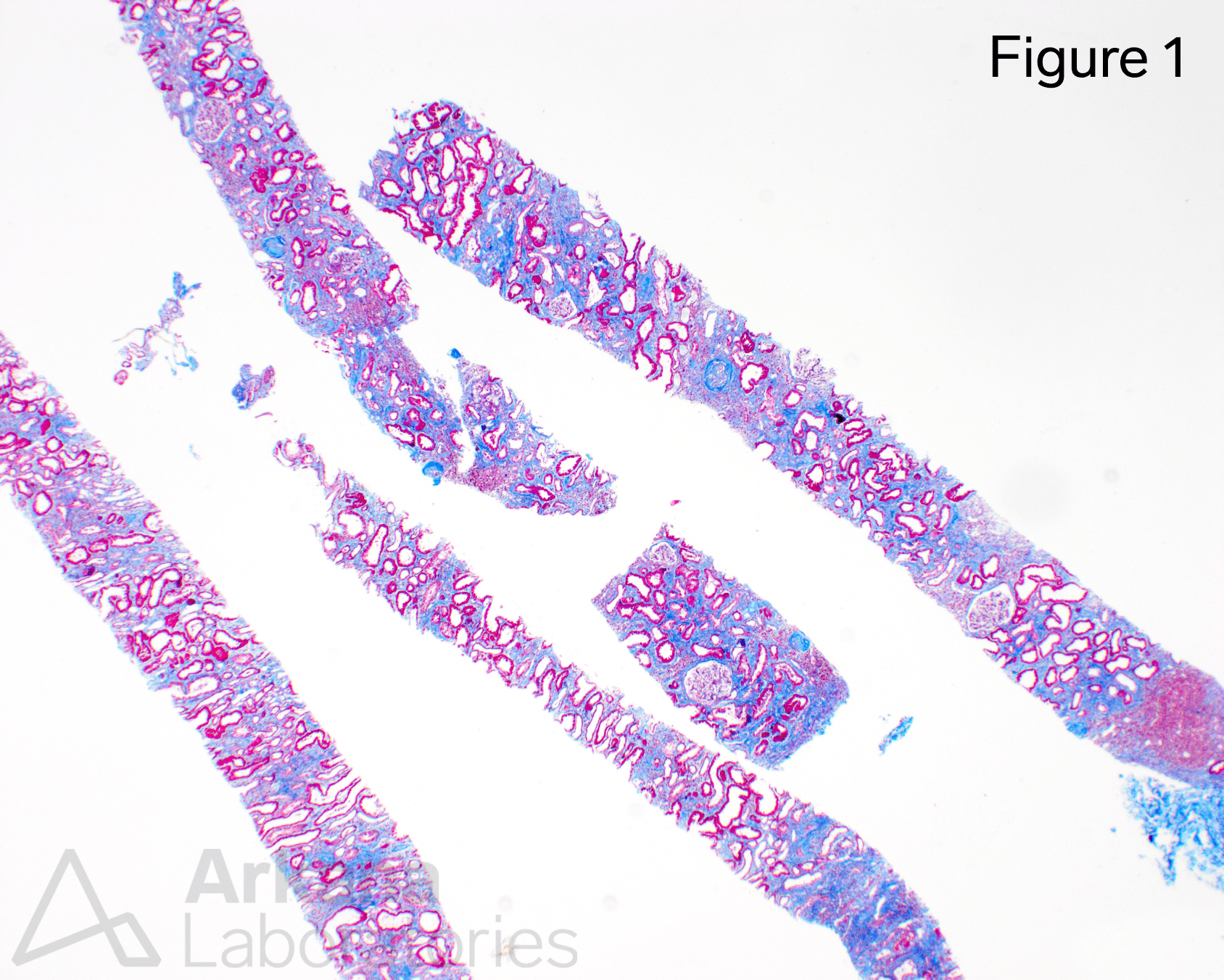 NPHP1-related nephronophthisis