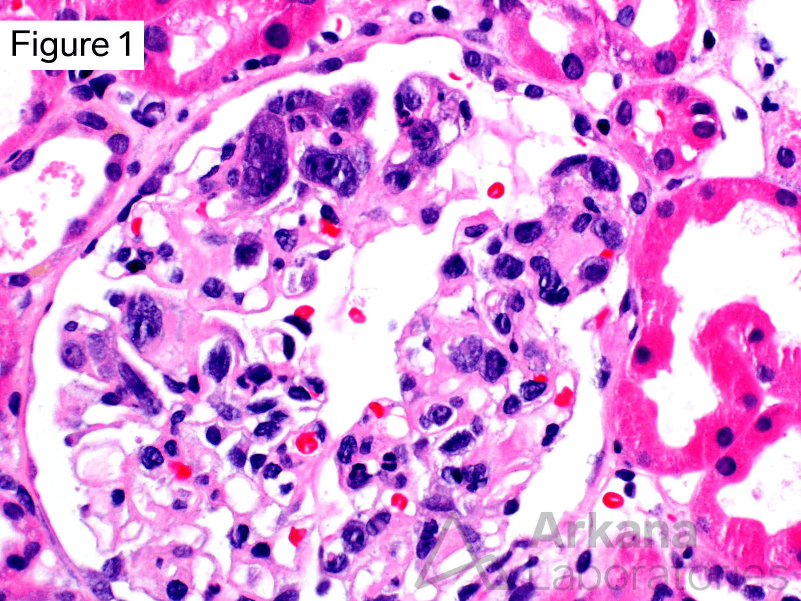 highly atypical cells within the glomerular capillaries, with high nuclear to cytoplasm ratio, irregular nuclear membranes, loose chromatin, and often several prominent nucleoli, Intravascular B-Cell Lymphoma