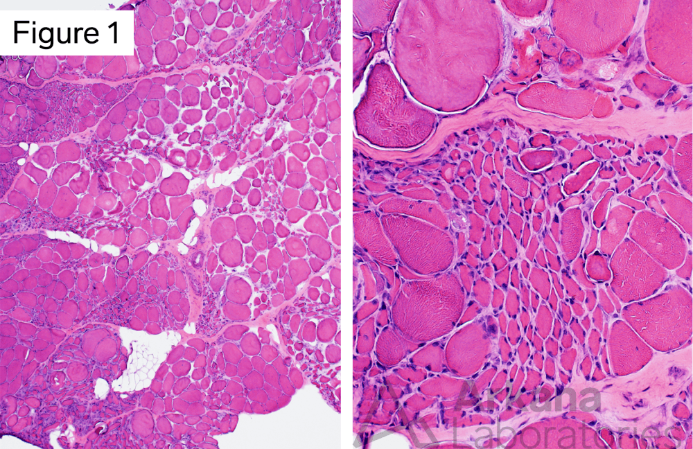 denervation (neurogenic atrophy)