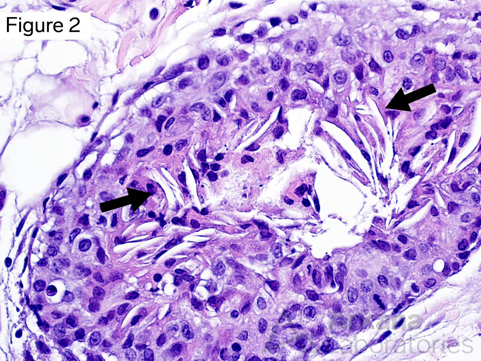 cells have cytomorphologic features of macrophages