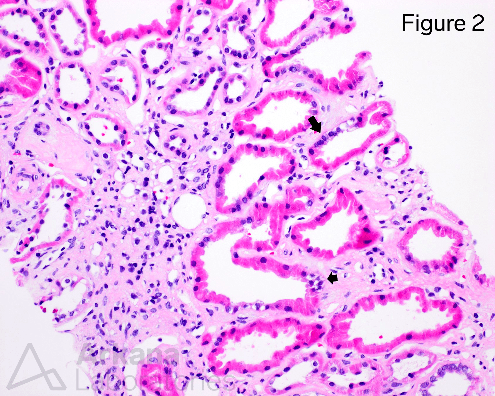 renal biopsy shows diffusely dilated tubules, with multidirectional branching, small diverticuli, and focal macula densa-like changes