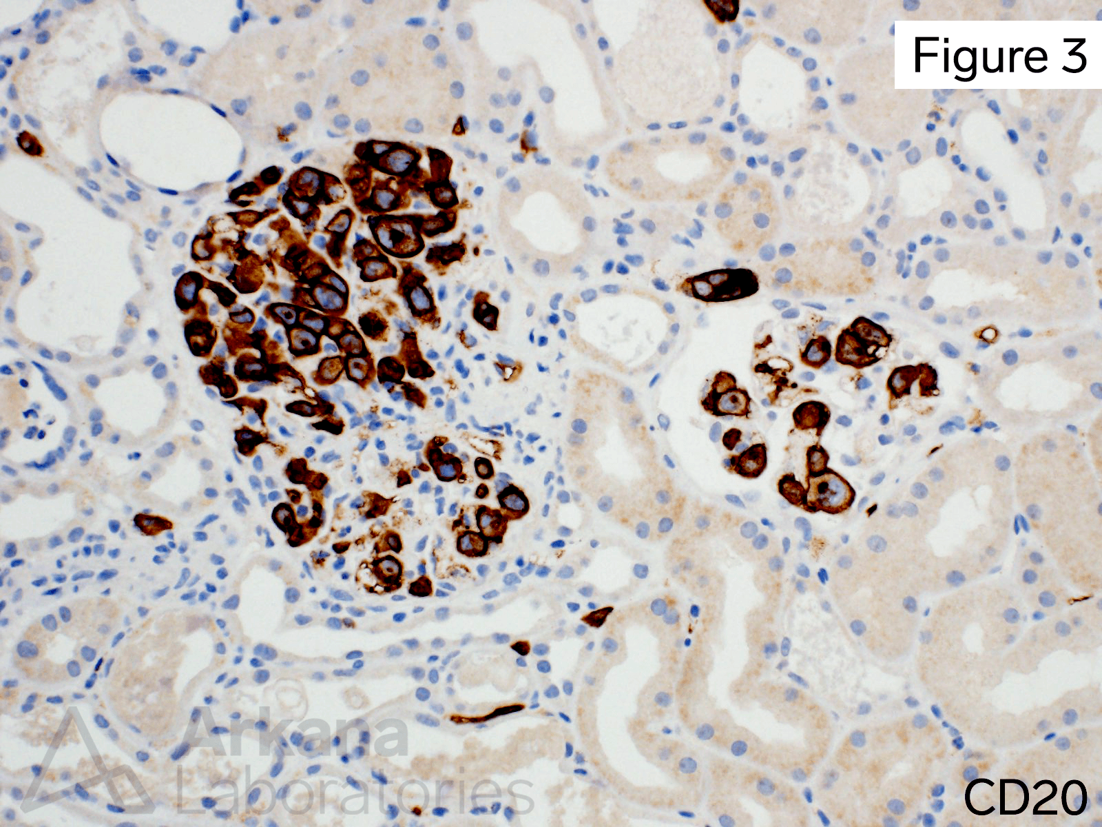 intravascular B-cell lymphoma,cells were positive for CD20