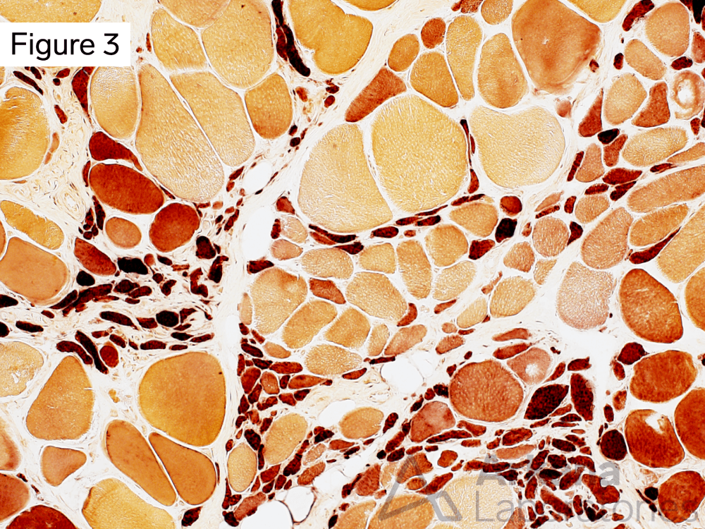 Many of the atrophic muscle fibers show diffuse moderate to marked increase in sarcoplasmic staining for esterase enzyme histochemical stain