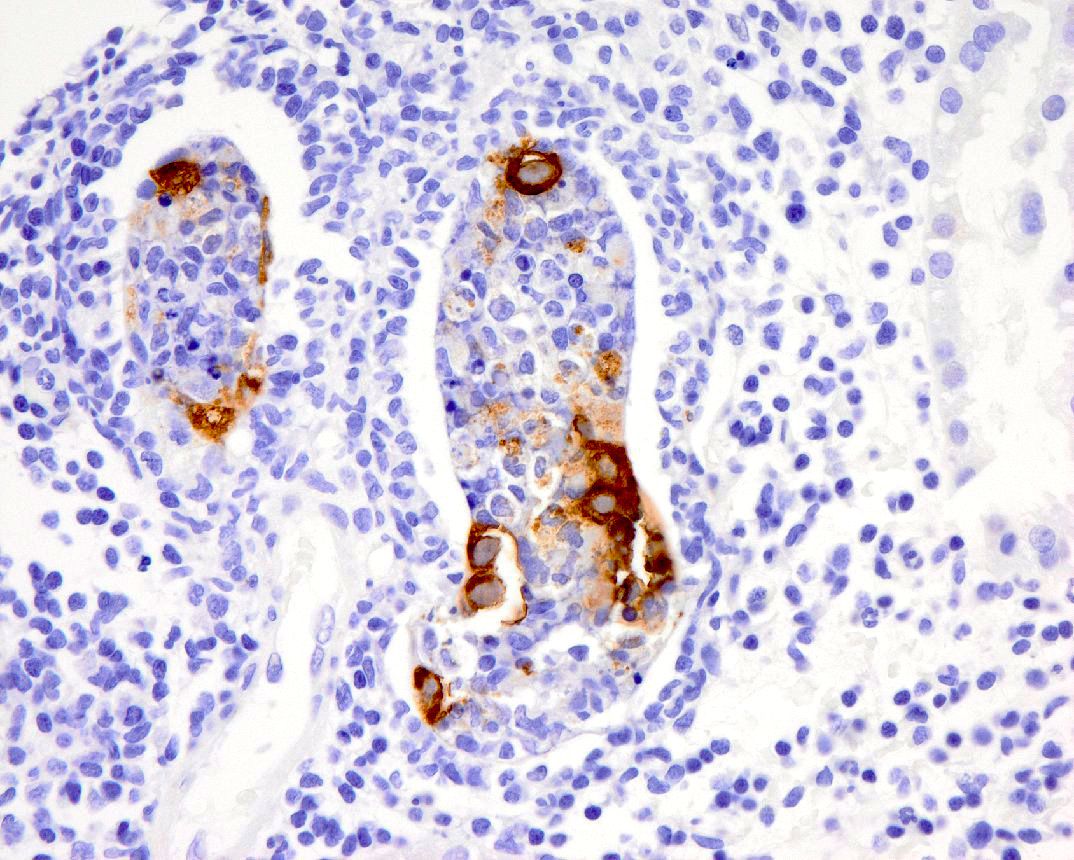 Positive adenovirus stain