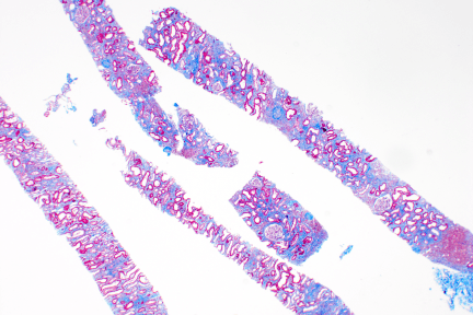 NPHP1-related nephronophthisis