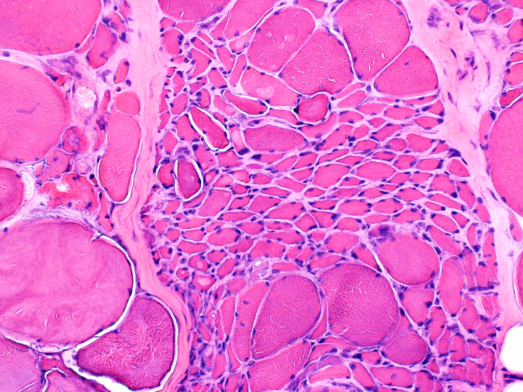 Gradient Denervation Denervation (Neurogenic Atrophy) | Neuro Notes with Dr. Wilson