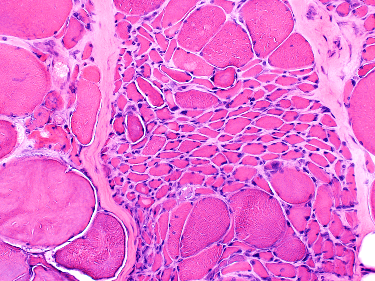 denervation (neurogenic atrophy)