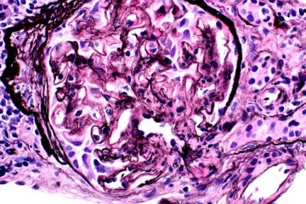 ABMR ALECT2 Fibrillary Glomerulopathy