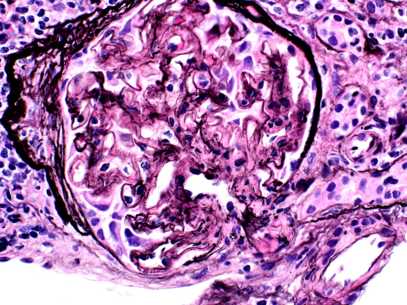 ABMR ALECT2 Fibrillary Glomerulopathy