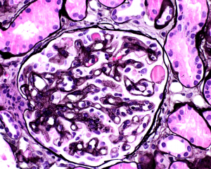 The biopsy shows glomerular capillary wall double contouring, segmental glomerular microaneurisms and hyalinosis. These findings are typical of anti-VEGF therapy-induced glomerular microangiopathy.