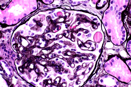 The biopsy shows glomerular capillary wall double contouring, segmental glomerular microaneurisms and hyalinosis. These findings are typical of anti-VEGF therapy-induced glomerular microangiopathy.