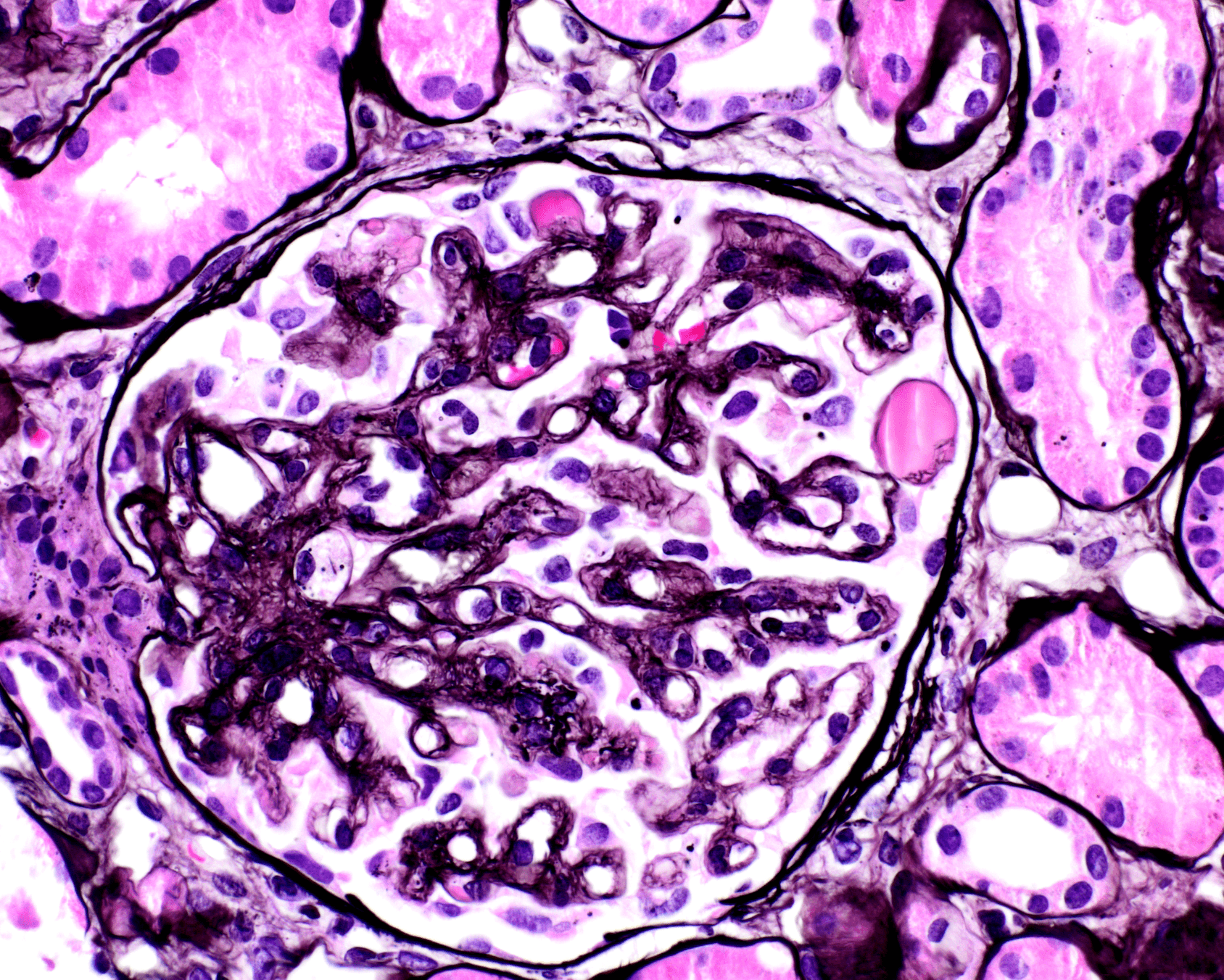 The biopsy shows glomerular capillary wall double contouring, segmental glomerular microaneurisms and hyalinosis. These findings are typical of anti-VEGF therapy-induced glomerular microangiopathy.