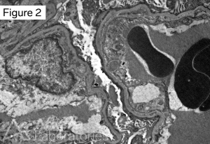 focal segmental glomerulosclerosis