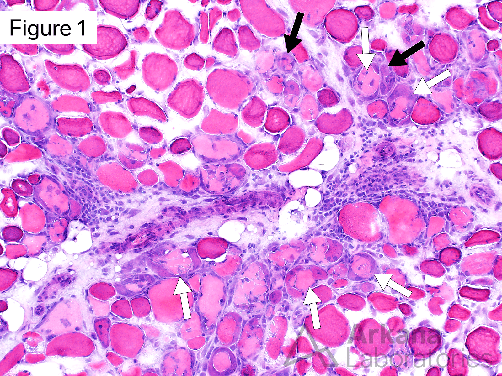 This medium magnification image shows basophilic regenerating (black arrows) and pale staining centrally necrotic muscle fibers (white arrows) in a perifascicular distribution. Note the presence of mild chronic lymphoid inflammation within the endomysium.