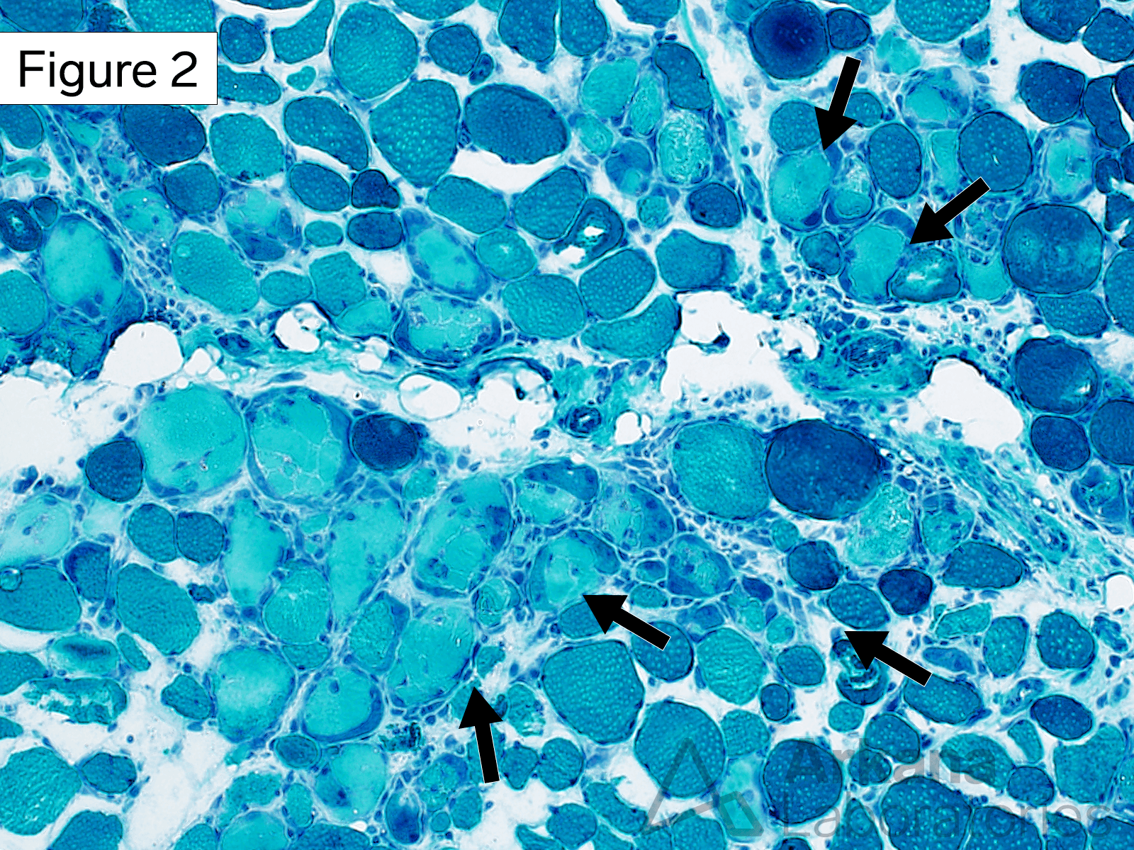 This medium magnification image also shows the pale staining centrally necrotic muscle fibers (white arrows) in a perifascicular distribution.