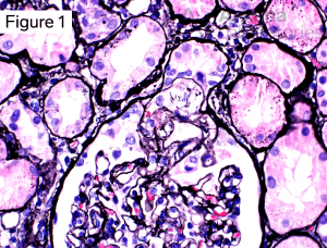 focal segmental glomerulosclerosis