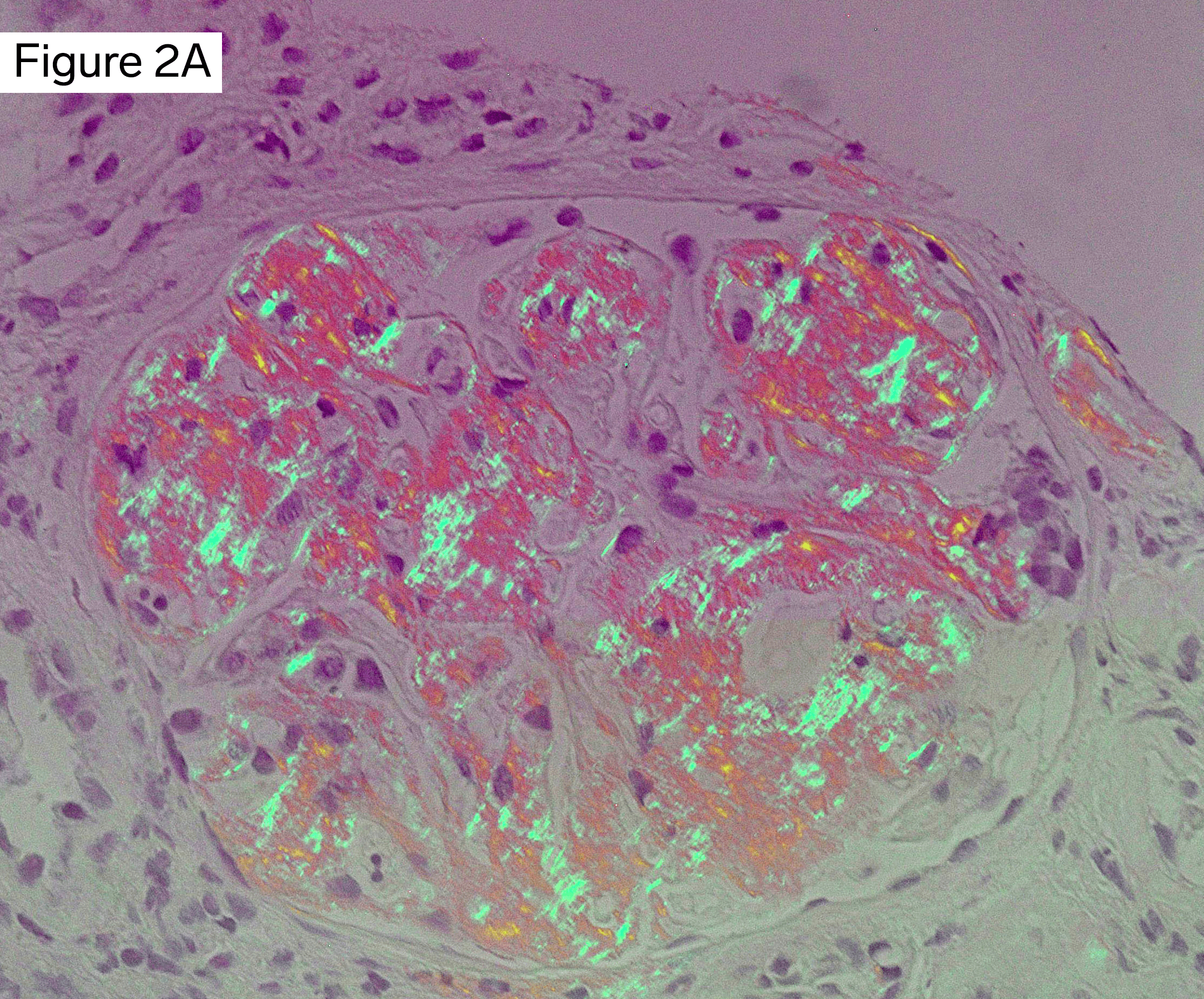 deposits stain positive on Congo red with apple-green birefringe, Amyloidosisnce upon polarization