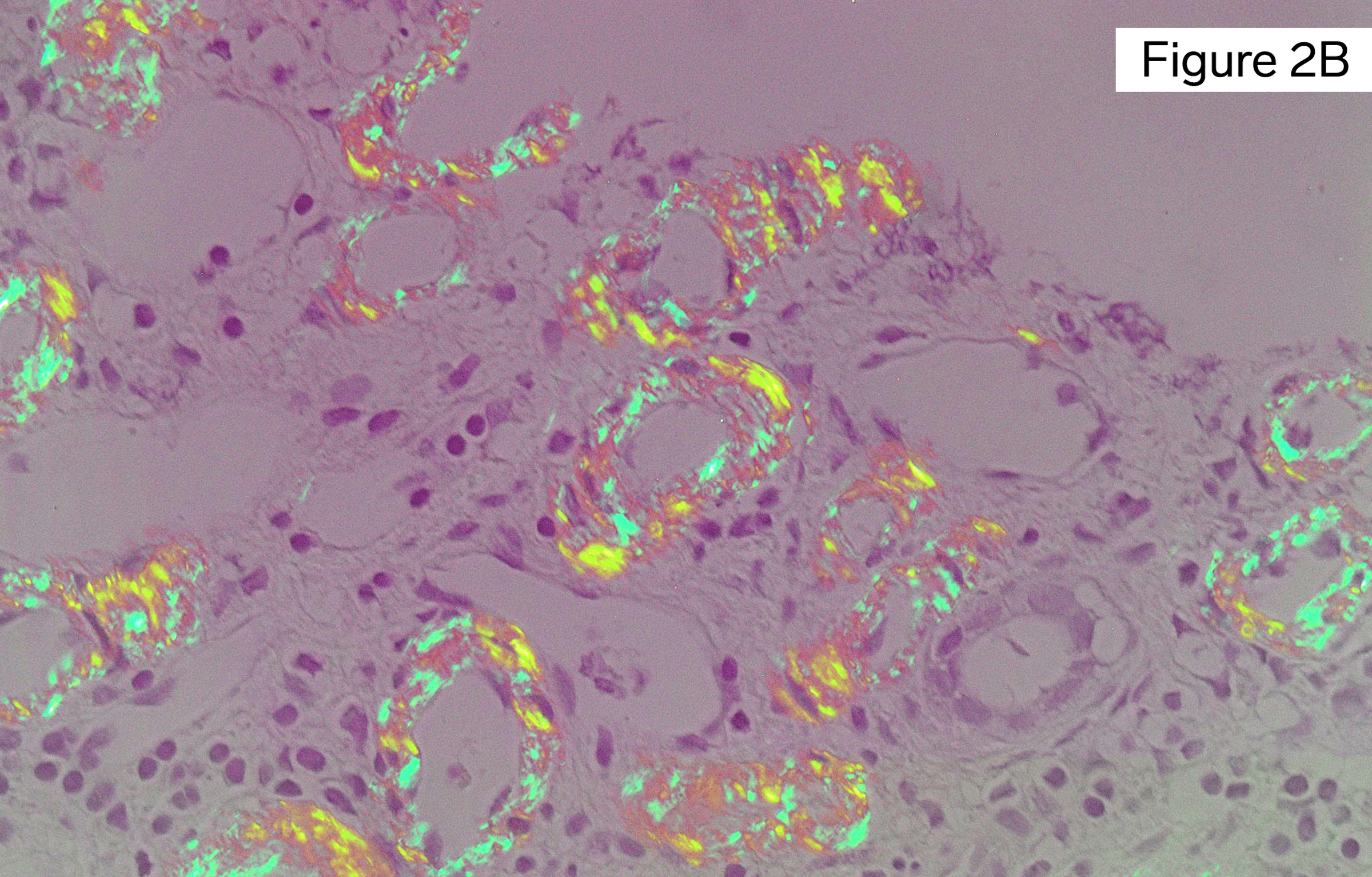 Amyloidosis, tubulointerstitial and vascular involvement