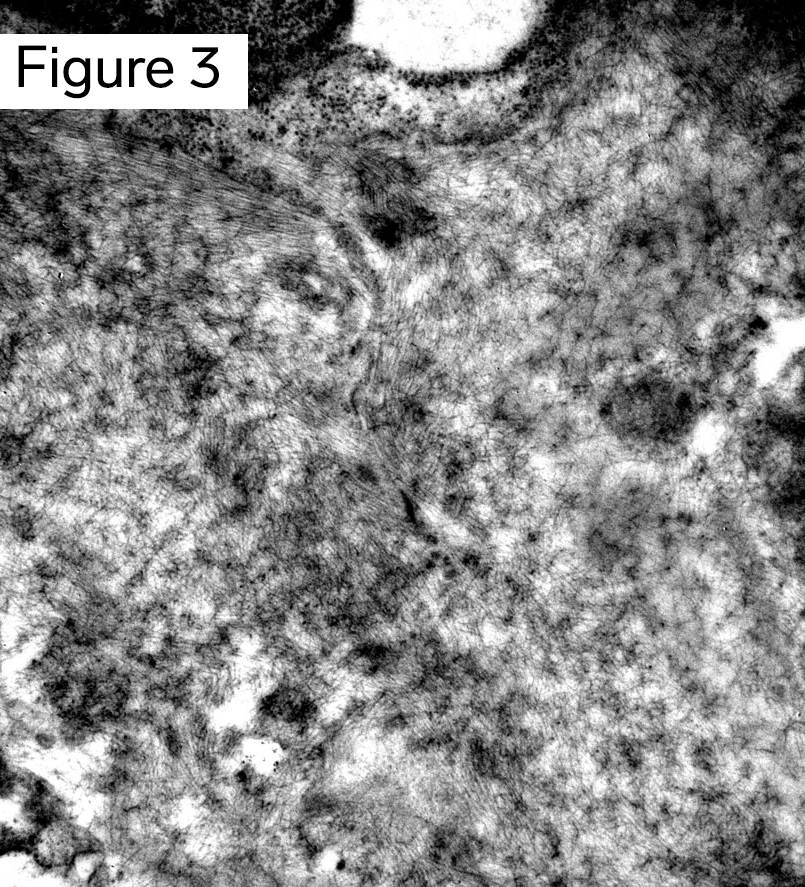 Amyloidosis, nonbranching fibrils 10 nm in diameter